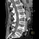 Paramedial protrusion of intervertebral disc, lumbar spine: CT - Computed tomography