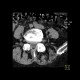 Paramedial protrusion of intervertebral disc, lumbar spine: CT - Computed tomography