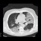 Pneumocystis pneumonia, PCP, Pneumocystis carinii: CT - Computed tomography
