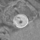 Percutaneous endoscopic gastrostomy, PEG: CT - Computed tomography