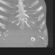 Percutaneous endoscopic gastrostomy, PEG: CT - Computed tomography