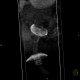 Percutaneous endoscopic gastrostomy, PEG: CT - Computed tomography