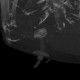 Percutaneous endoscopic gastrostomy, PEG: CT - Computed tomography