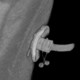 Percutaneous endoscopic gastrostomy, PEG: CT - Computed tomography