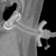 Percutaneous endoscopic gastrostomy, PEG: CT - Computed tomography