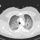 Lung oedema: CT - Computed tomography