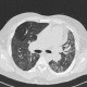 Lung fibrosis, alveolitis: CT - Computed tomography