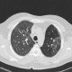 Lung fibrosis, alveolitis: CT - Computed tomography