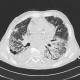 Lung fibrosis, pneumonia, pleural effusion: CT - Computed tomography