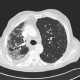 Lung fibrosis, pneumonia, pleural effusion: CT - Computed tomography