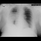 Pneumonia, abscess, bronchiectasis: X-ray - Plain radiograph