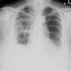 Pneumonia, abscess, bronchiectasis: X-ray - Plain radiograph