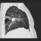 Pneumonia, abscess, bronchiectasis: CT - Computed tomography