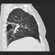Pneumonia, abscess, bronchiectasis: CT - Computed tomography