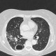 Pneumonia, abscess, bronchiectasis: CT - Computed tomography