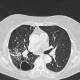 Pneumonia, abscess, bronchiectasis: CT - Computed tomography