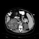 Polycystosis of kidney, adult polycystic kidney disease, ADPKD, liver cysts, Tenckhoff catheter, peritoneal dialysis: CT - Computed tomography