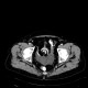 Polycystosis of kidney, adult polycystic kidney disease, ADPKD, liver cysts, Tenckhoff catheter, peritoneal dialysis: CT - Computed tomography