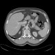 Polyp of transverse colon: CT - Computed tomography