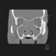 Polyposis of nose and paranasal sinuses: CT - Computed tomography