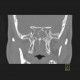 Polyposis of nose and paranasal sinuses: CT - Computed tomography