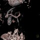 Portocaval shunt in liver, VRT: CT - Computed tomography