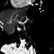 Portocaval shunt in liver, VRT: CT - Computed tomography