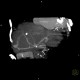 Porto-venous shunt of the liver: CT - Computed tomography