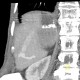 Porto-venous shunt of the liver: CT - Computed tomography