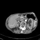 Porto-venous shunt of the liver: CT - Computed tomography