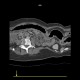 Ulcerative colitis, enterography: CT - Computed tomography