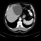 Cyst in liver, simple cyst, large: CT - Computed tomography