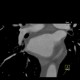 Web in the truncus intermedius: CT - Computed tomography