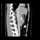 Solid pseudopapillary tumor of pancreas: CT - Computed tomography