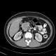 Solid pseudopapillary tumor of pancreas: CT - Computed tomography