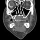 Eyeball, secondary finding, unknown pathology: CT - Computed tomography