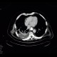 Leak of anastomosis of esophagus in pleural cavity, gastroesophageal anastomosis, stent: CT - Computed tomography