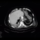 Leak of anastomosis of esophagus in pleural cavity, gastroesophageal anastomosis, stent: CT - Computed tomography