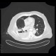 Leak of anastomosis of esophagus in pleural cavity, gastroesophageal anastomosis, stent: CT - Computed tomography