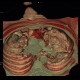 Pancoust tumor, extension into spine, lung cancer, pulmonary carcinoma, VRT: CT - Computed tomography