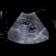 Parapelvic cysts, intrasinusoidal, central cysts: US - Ultrasound