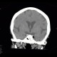 Lipoma, parasellar: CT - Computed tomography