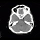 Lipoma, parasellar: CT - Computed tomography