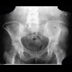 Pathologic fracture of pelvis: X-ray - Plain radiograph