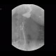 Bariatric surgery, pean: RF - Fluoroscopy