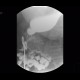 Bariatric surgery, pean: RF - Fluoroscopy