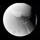 Bariatric surgery, pean: RF - Fluoroscopy