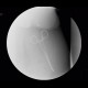 Bariatric surgery, pean: RF - Fluoroscopy
