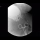 Bariatric surgery, pean: RF - Fluoroscopy