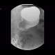 Bariatric surgery, pean: RF - Fluoroscopy